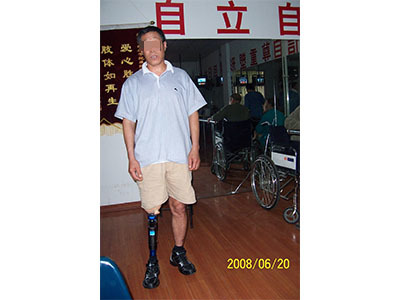 青島市遠征假肢矯形器 專業(yè)假肢與矯形器的選擇與服務
